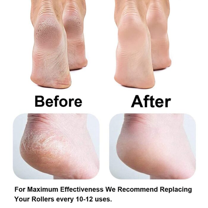 Callus Remover